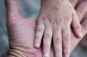 چه کسانی برای سفر به اربعین باید واکسن سرخک بزنند؟