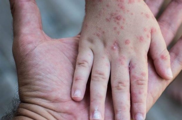 چه کسانی برای سفر به اربعین باید واکسن سرخک بزنند؟